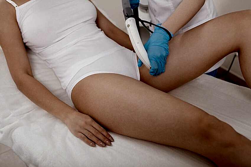 Genital bölge lazer epilasyon